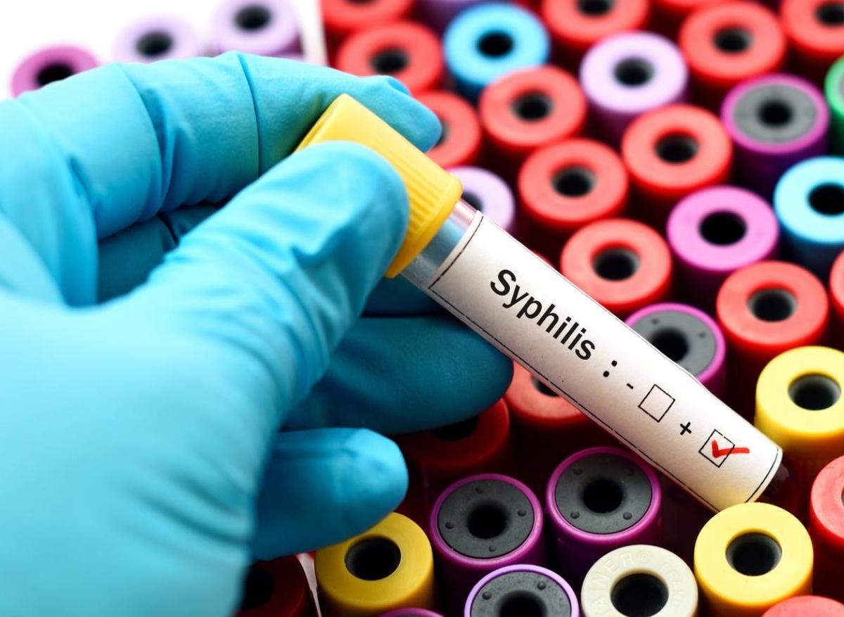 Syphilis : la recrudescence des cas aux USA s’accompagne de symptômes inhabituels 