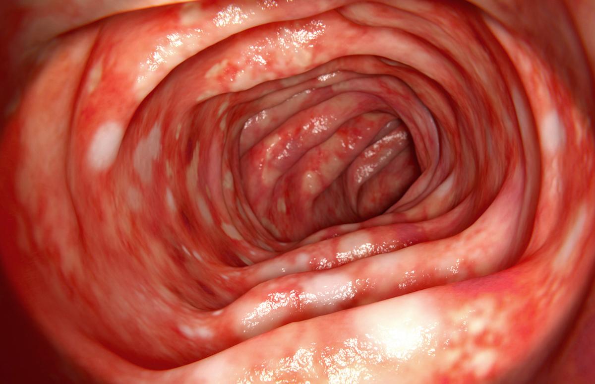 Rectocolite hémorragique : une nouvelle molécule à inscrire dans une stratégie dynamique