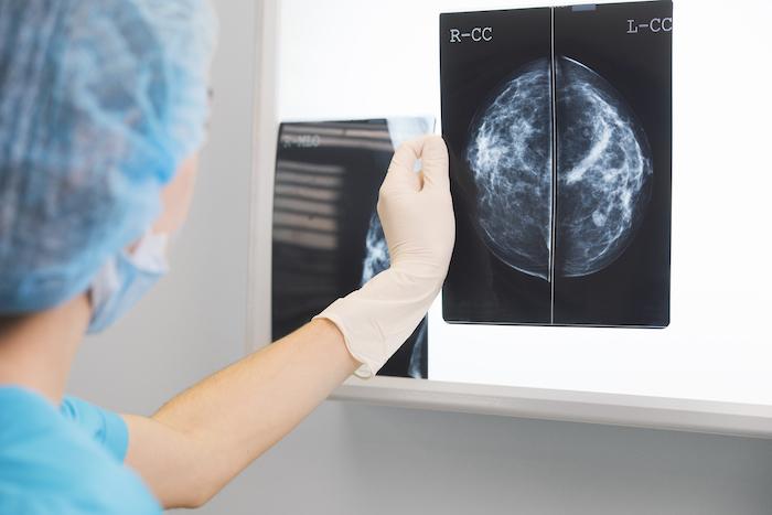 Cancer du sein triple négatif : la moitié temporairement résistante à la chimiothérapie
