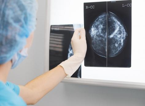 Cancer du sein : le test TAILORx peut être amélioré par les critères cliniques