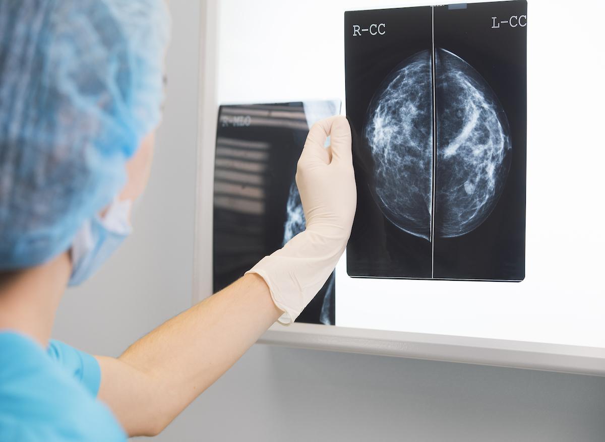 Cancer du sein : comment les cellules tumorales se propagent dans les ganglions 