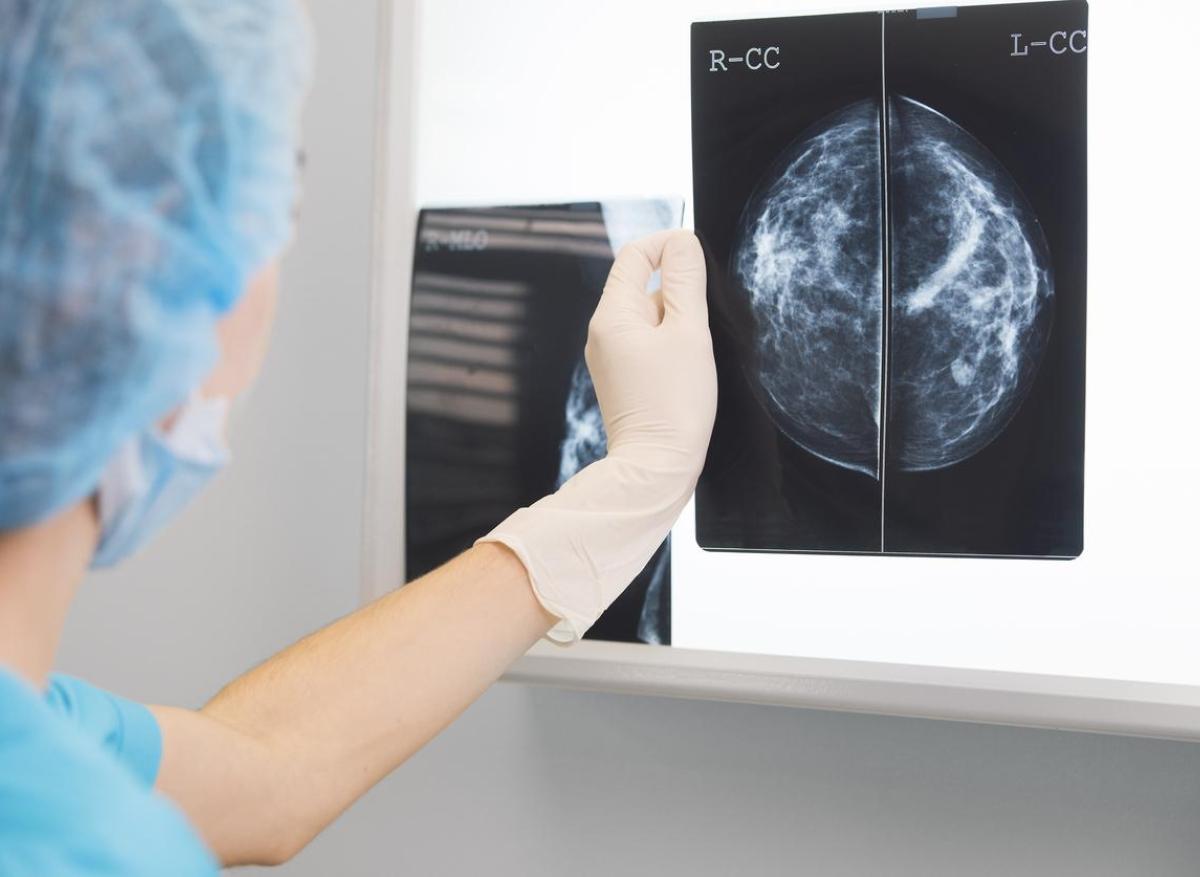 Cancer du sein triple négatif : moins de rechute si certains lymphocytes infiltrent la tumeur