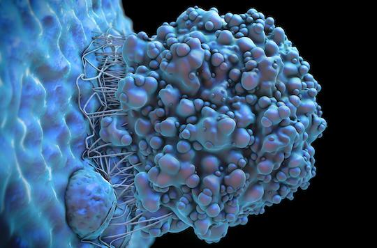 Mélanome stade 4 : association d’immunothérapies en adjuvant