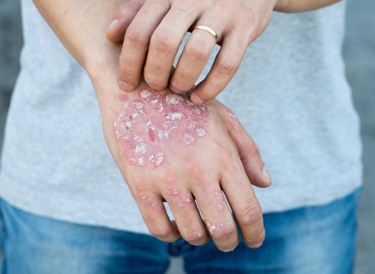 Psoriasis : un sondage illustre les idées fausses sur la maladie