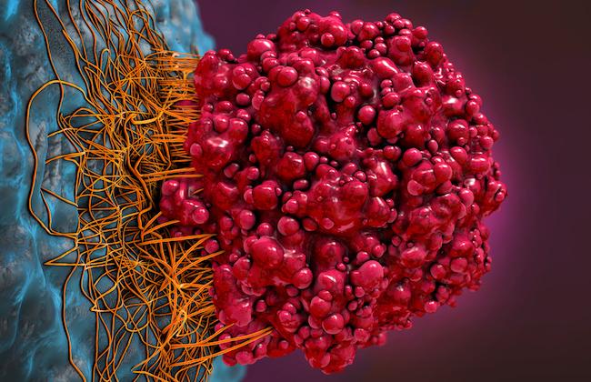 Mélanome métastasé : les effets indésirables auto-immuns des iBRAF prédictifs d’une réponse durable 