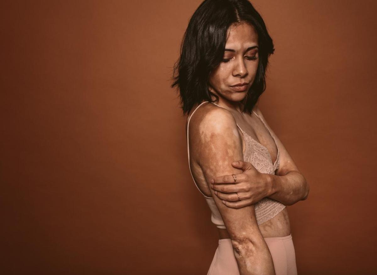 Vitiligo : un 1er traitement anti-JAK pour repigmenter la peau autorisé en Europe 