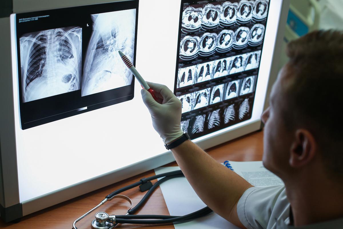 Cancer du poumon : le dépistage efficace chez les patients à haut risque mais pas assez réalisé