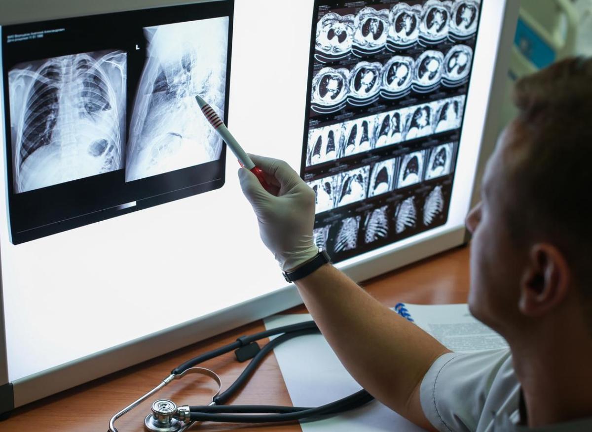 Carcinome épidermoïde du poumon : le gène KMT2D serait lié à la maladie 