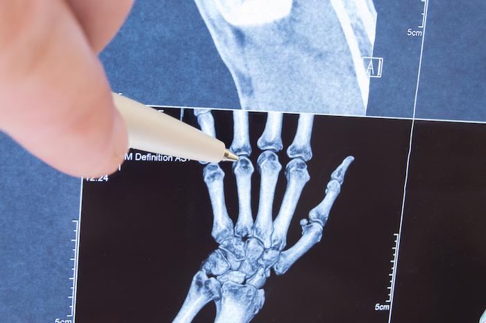Rhumatismes : parlez avec les chercheurs qui combattent les maladies articulaires et osseuses 