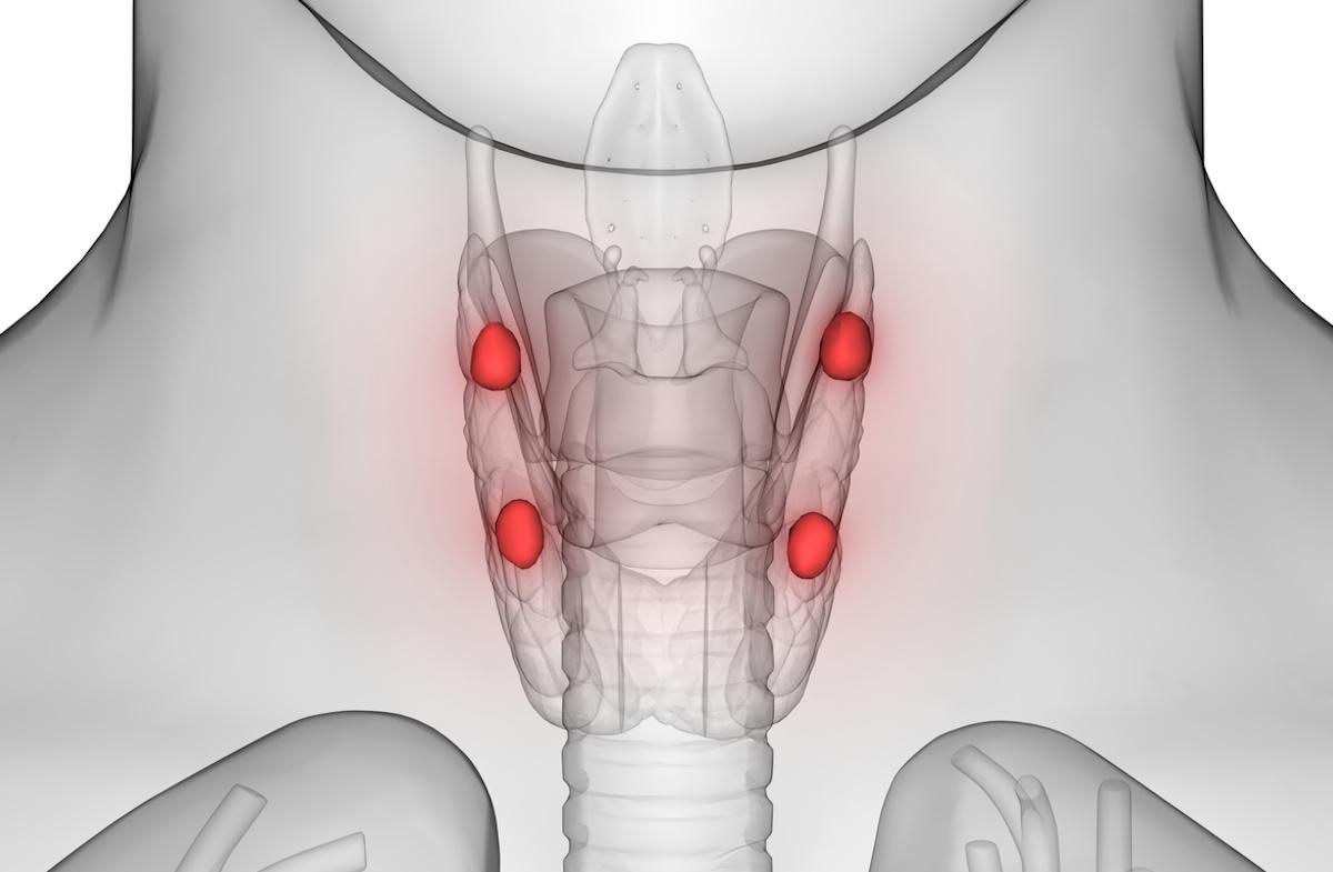 Hyperparathyroïdie primaire : opérer ou pas pour réduire le risque de fractures ?