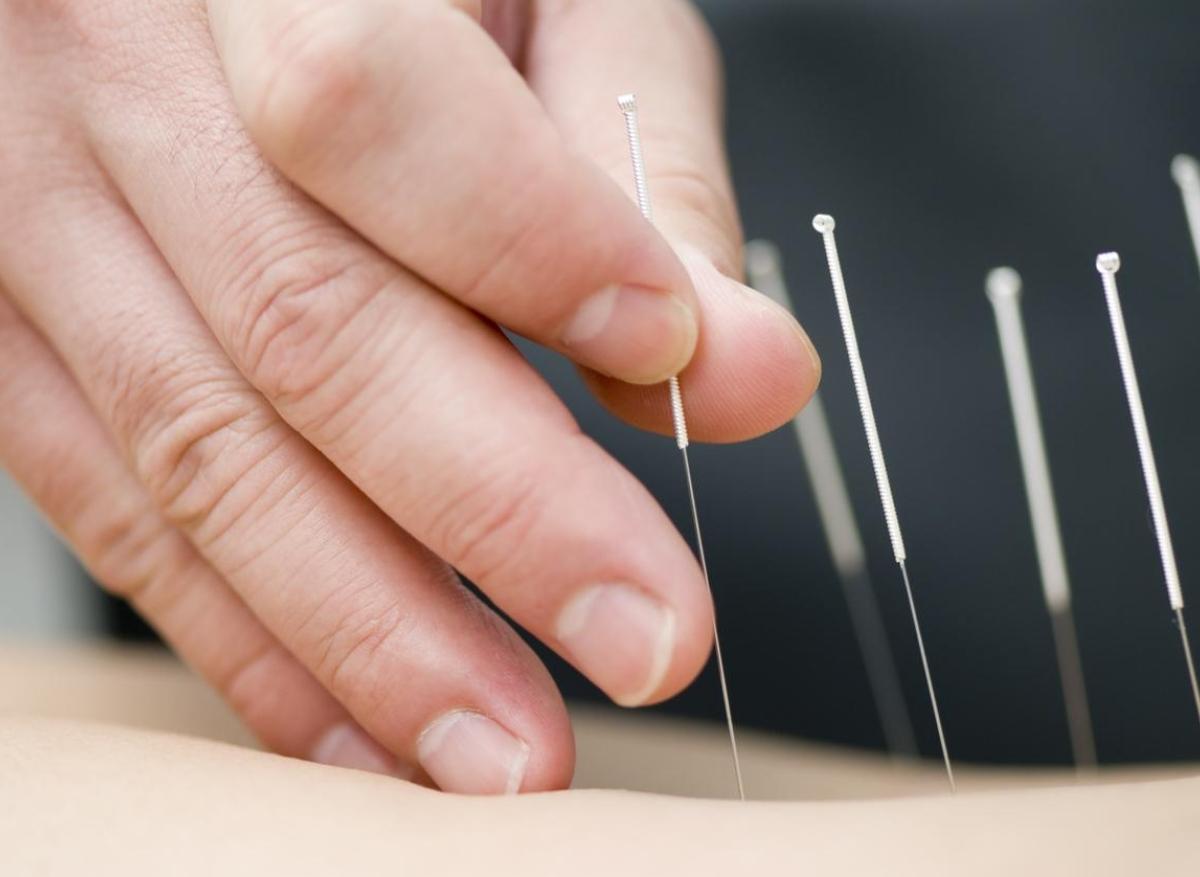 Grossesse : l'acupuncture contre les douleurs lombaires et pelviennes