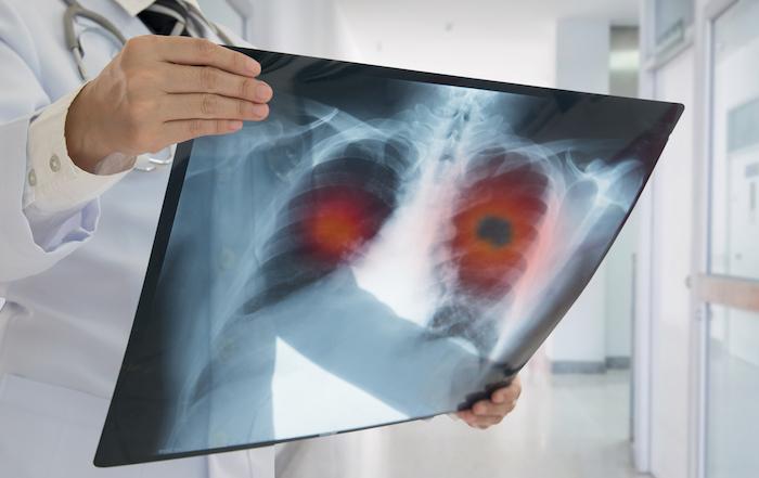Cancer du poumon au stade précoce : vers un changement de stratégie de traitement ?