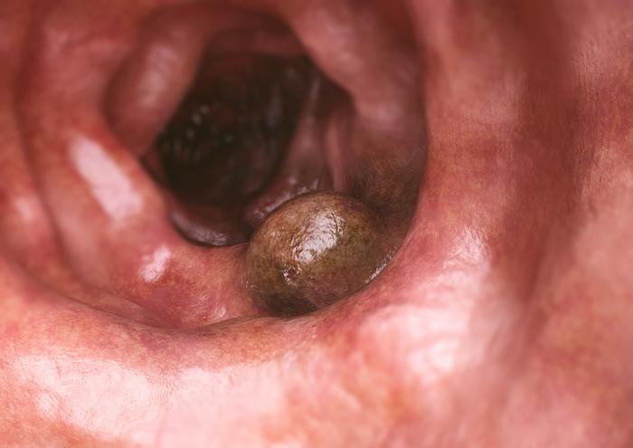 Cancer colorectal : intérêt de l’immunothérapie après échec d’une thérapie ciblée