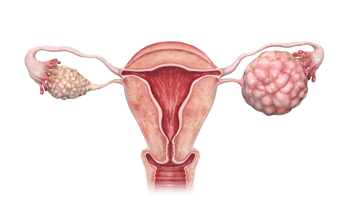 Cancer de l’ovaire résistant aux platines : enfin de l’amélioration ?