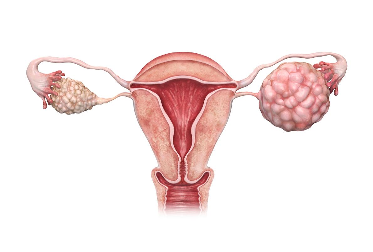 Cancers de l’ovaire : pas de bénéfice des anti-PDL1 dans la prise en charge précoce