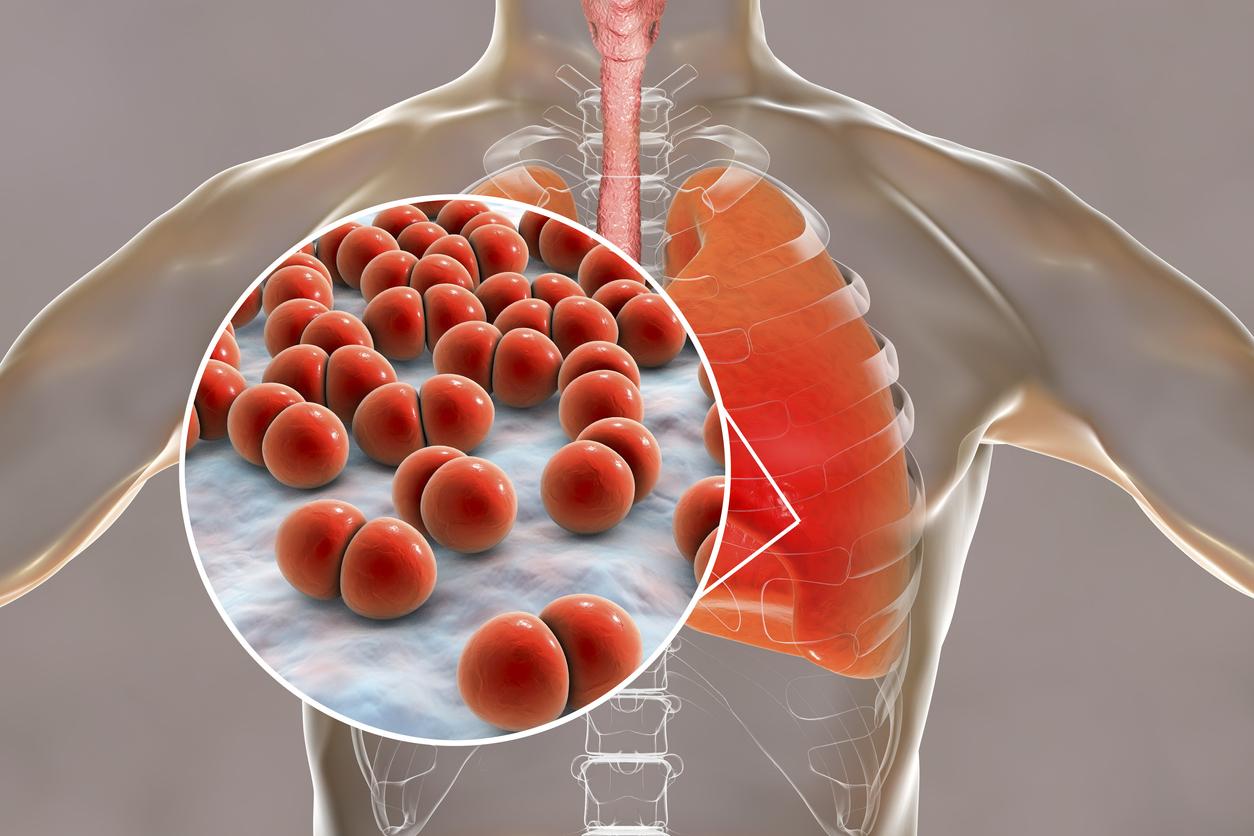 BPCO: un lien entre les fibrocytes et la détérioration de la paroi bronchique