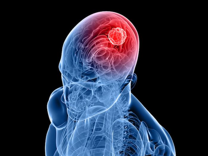 Neurofibromatose : une avancée dans le traitement des tumeurs cérébrales 