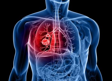 Cancer du poumon : l’intelligence artificielle améliore le dépistage