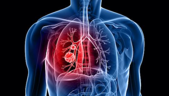 Cancer du poumon PS≥2 : bénéfice clinique et tolérance acceptable de l’immunothérapie 