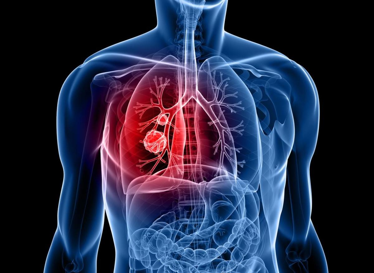 Tumeur du poumon : 1ère ablation non-chirurgicale en France