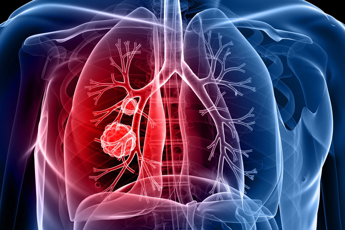 Tumeurs broncho-pulmonaires carcinoïdes : le ProGRP comme biomarqueur ?
