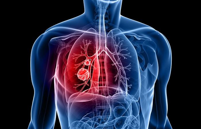 Cancer bronchique métastasé : l’immunothérapie associée à la chimiothérapie diminue de 50% le risque de progression et de décès
