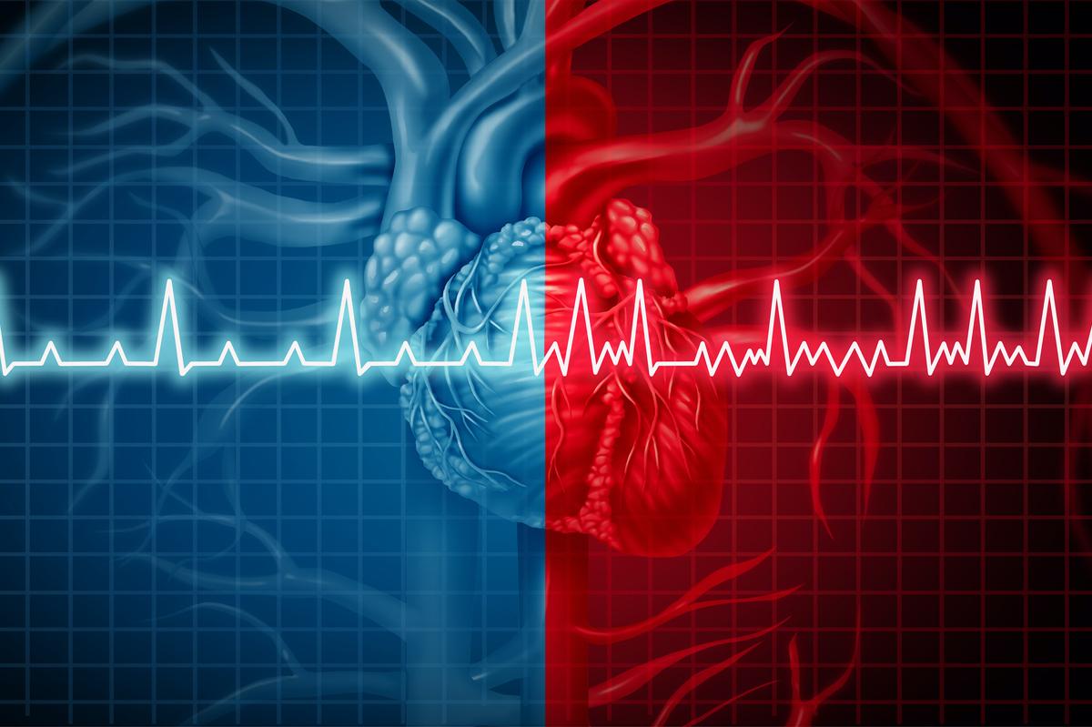 Fibrillation atriale : les nouveautés des recommandations ESC 2020 