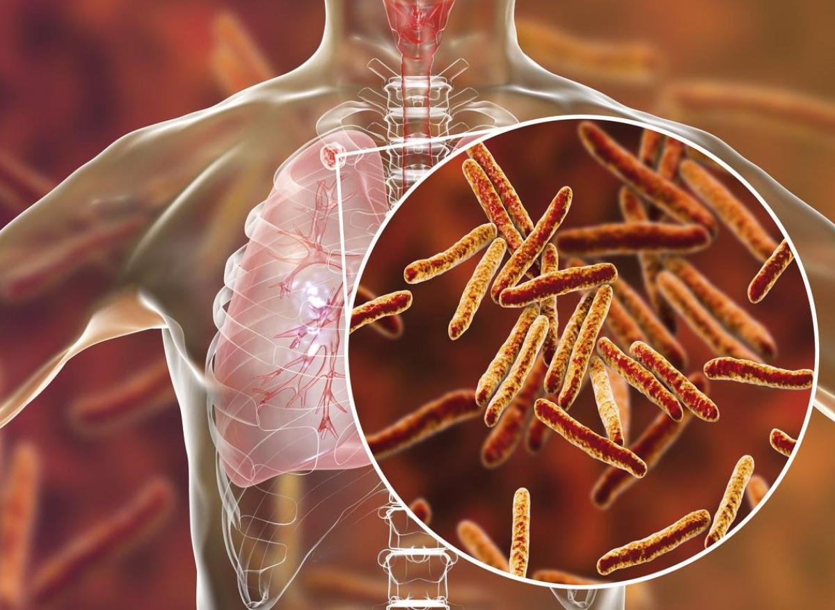 Tuberculose : bientôt le dépistage par breath-test ?