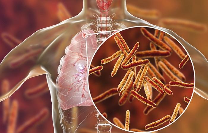 Tuberculose résistante à la Rifampicine :  une non-infériorité du régime court