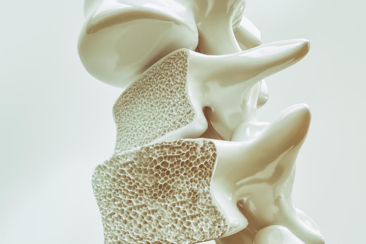 Ostéoporose : un anti-sclérostine augmente particulièrement l’os cortical
