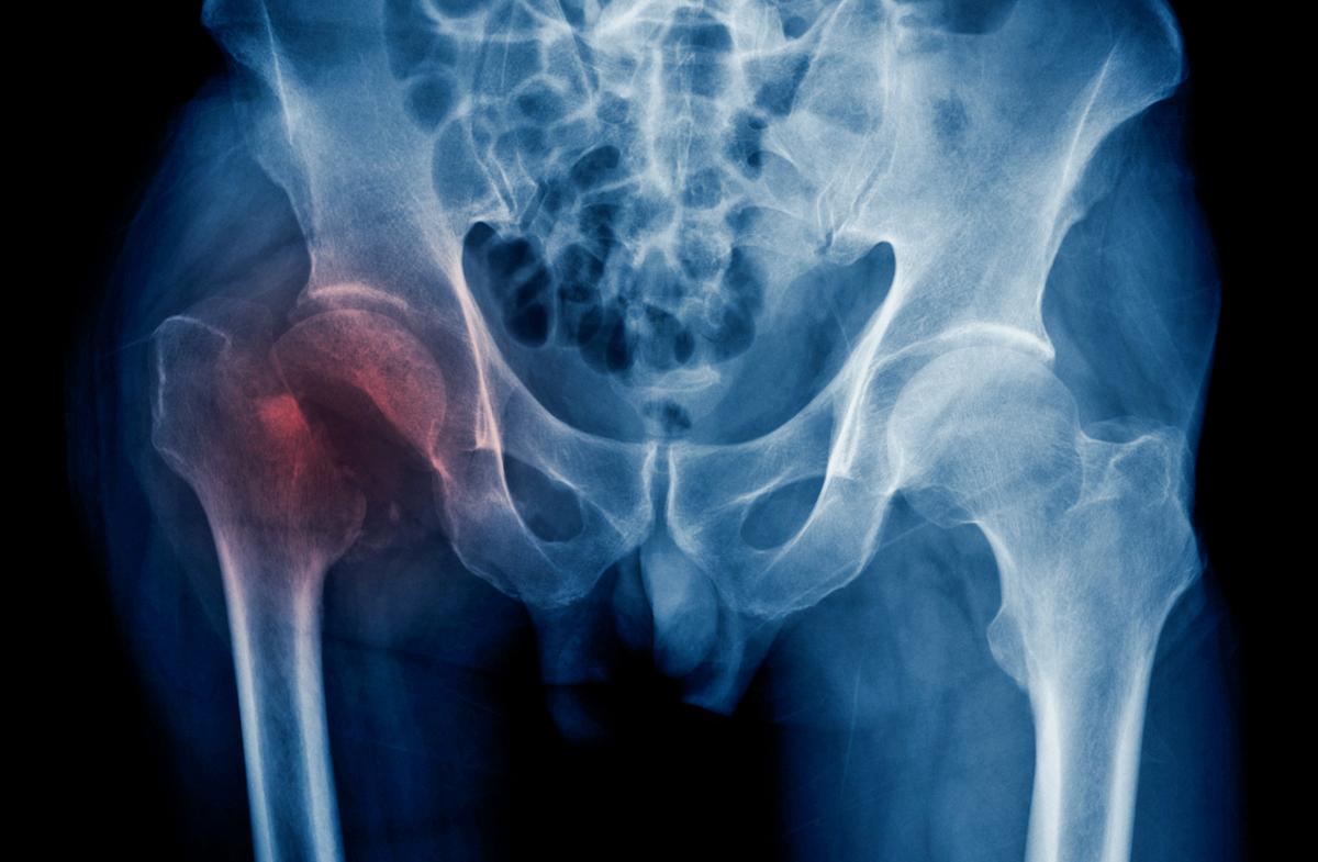 Ostéoporose post-ménopausique : perte osseuse limitée au col fémoral