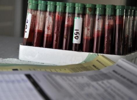 Tuberculose : bientôt un test sanguin diagnostique et pronostique