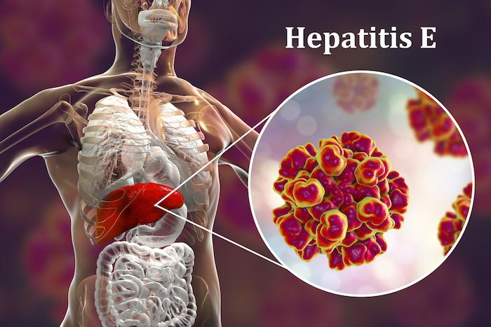 Hépatite E : le nombre de cas explose en France