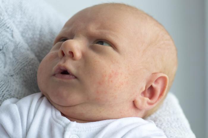 Fièvre du nourrisson : un nouvel test pour aider au diagnostic des infections bactériennes