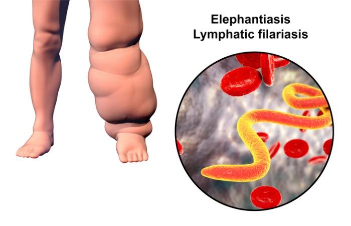 Filariose lymphatique (éléphantiasis) : un traitement triple marche dans 100% des cas 