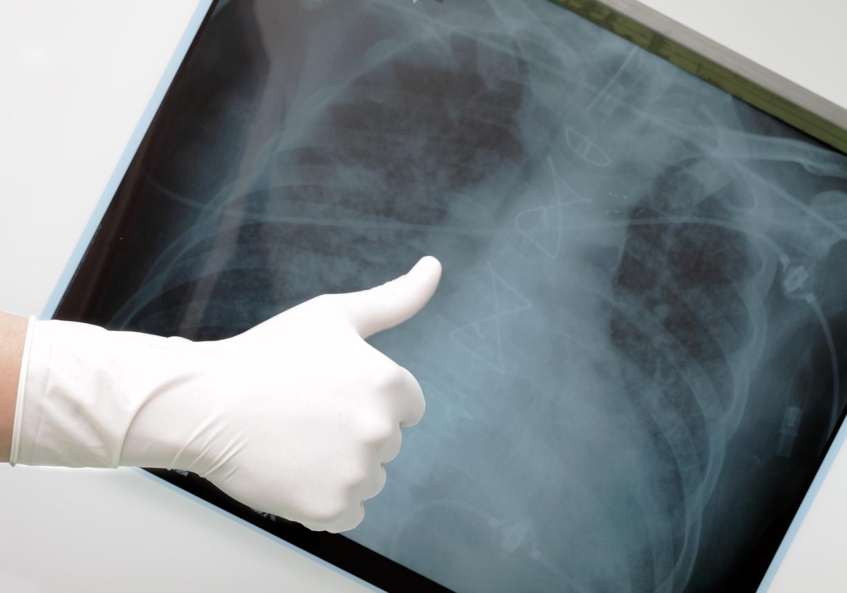 Pneumothorax : pas de non-infériorité de la simple surveillance