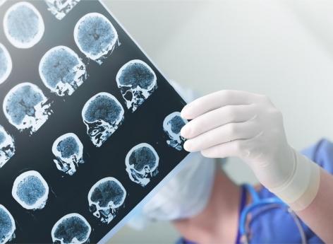 Alzheimer : un déficit d’activité des cellules immunitaires du cerveau expliquerait la maladie