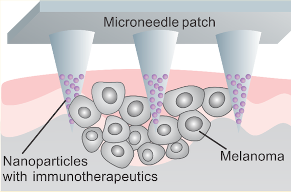 Mélanome : un patch pour une immunothérapie plus ciblée 