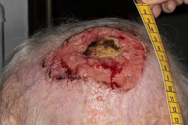 Un carcinome basocellulaire localement avancé (CBCla) et menaçant du cuir chevelu