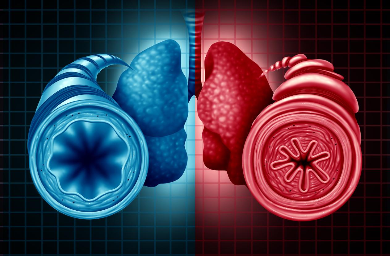 Bronchiolite constrictive : intérêt diagnostique des oscillations forcées. 