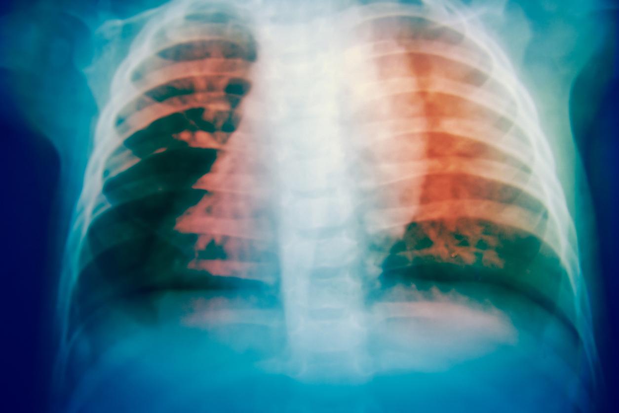 Pathologies pulmonaires interstitielles : des informations sur la progression en vie réelle