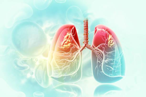 Asthme : un potentiel mécanisme auto-immun