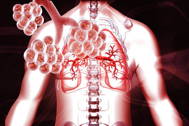 Emphysème de la fibrose pulmonaire : importance de le quantifier et d’utiliser la DLCO