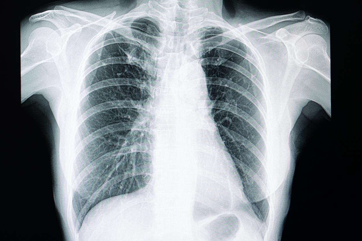 Traitement des fibroses pulmonaires idiopathiques : peu d’idées nouvelles mais quelques signaux