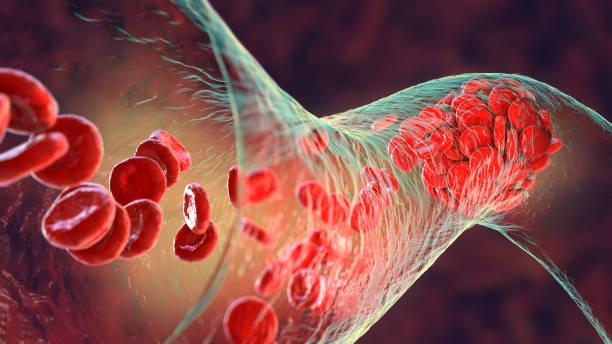 Perte de capacité d’exercice après une embolie pulmonaire : le déconditionnement n’est pas le seul responsable