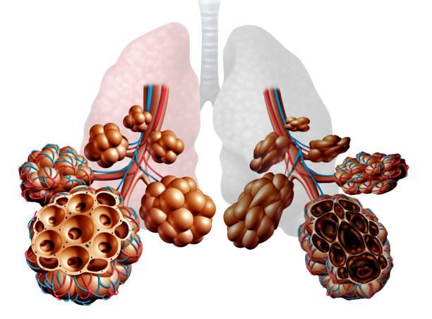 Valves endo-bronchiques : envisageables  pour les patients plus sévères