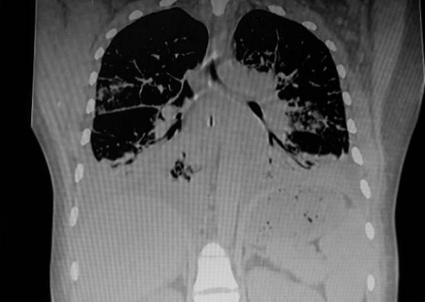 Chylothorax, ce mal connu