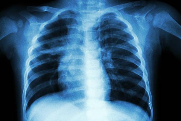 Pneumopathies interstitielles de l’enfant : une approche diagnostique complexe