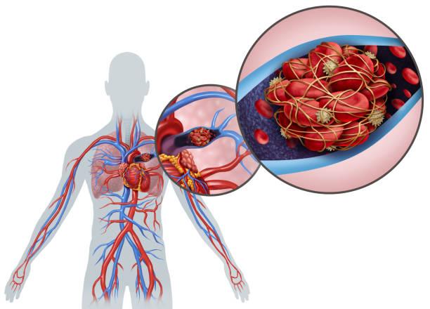 Hypertension pulmonaire post-embolique : un pronostic transformé par le dépistage