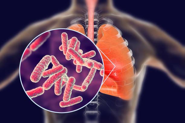 Tuberculose pulmonaire latente : Qui ? Quand ? Comment ?